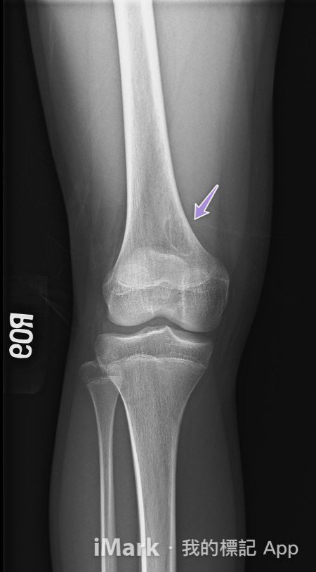 台北榮總骨腫瘤中心主任吳博貴指出，在X光影像中，非骨化纖維瘤看似骨骼破了一個大洞...