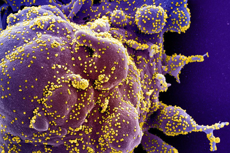 電子顯微鏡圖像顯示遭新冠病毒（黃色）感染的細胞（紫色）。路透