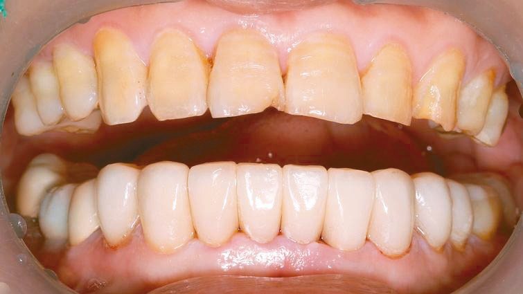 「深咬」易造成下顎前牙過度磨耗；治療是以肌功能訓練重建咬合關係，再以假牙膺復方式重建牙齒外型(圖)。圖／黃玄倫提供