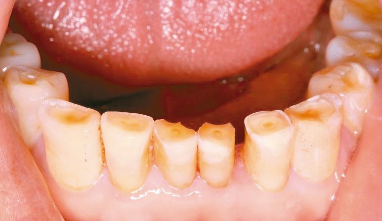「深咬」易造成下顎前牙過度磨耗(圖)；治療是以肌功能訓練重建咬合關係，再以假牙膺...