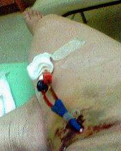病友張玉此因為TTP發作，七度接受血漿置換。圖／張玉此提供