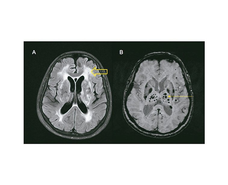 血管型失智症患者腦部MRI可見嚴重白質病變(A圖粗箭頭處)，或有許多微小出血點(...