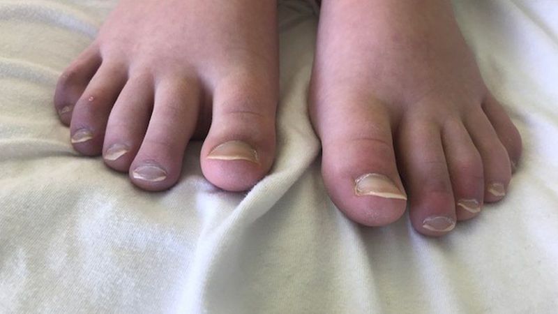 青少女脚趾肿胀不能穿鞋。图／取自(photo:UDN)