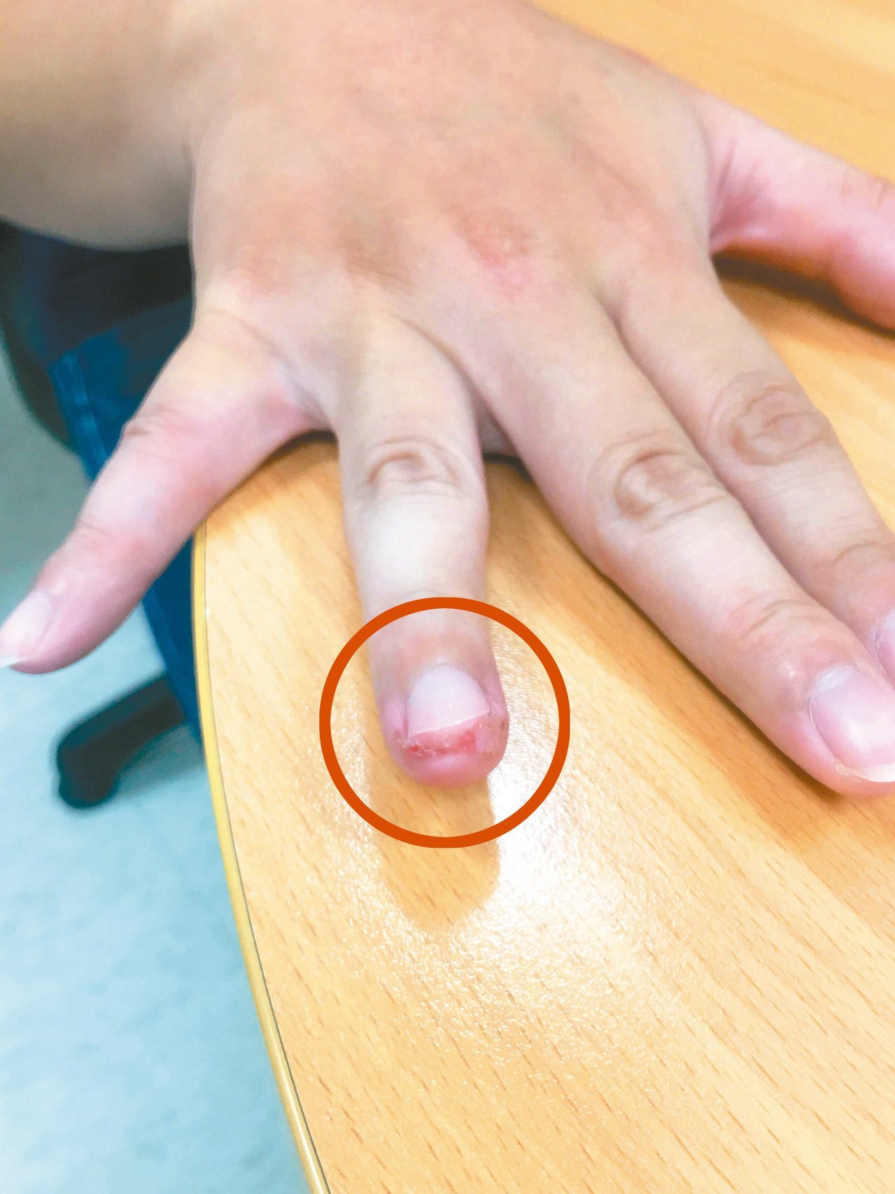 右手無名指甲前端為典型病毒疣，容易接觸傳染，常是多發性，治療後也常復發。圖／林欣儀提供