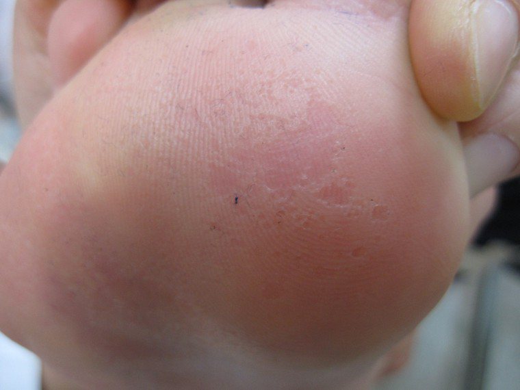 足蹠蠹蝕症腳底出現蛀蝕小孔，伴隨惡臭。圖／台北市黃禎憲皮膚科診所提供