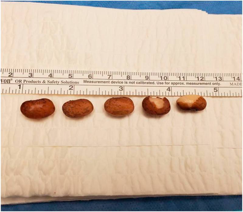 医生以人手挤压的方式挤出1颗腰豆，后来再做手术取出其余5颗。（Urology Case Reports图片）(photo:UDN)