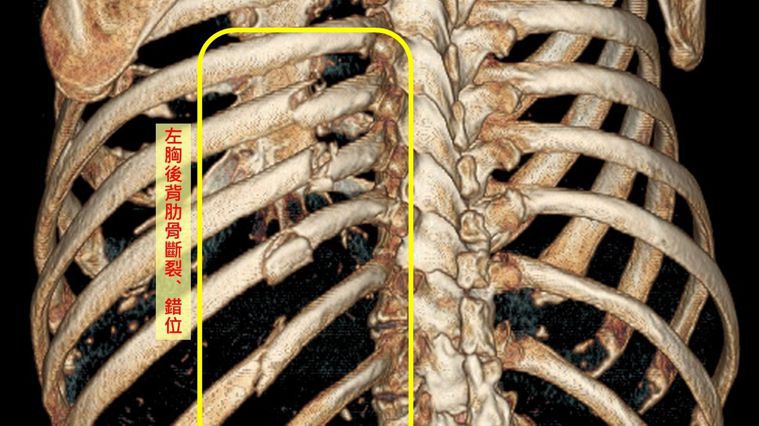 電腦斷層掃瞄影像顯示廖姓老翁肋骨斷裂、錯位。圖／台中慈濟醫院提供