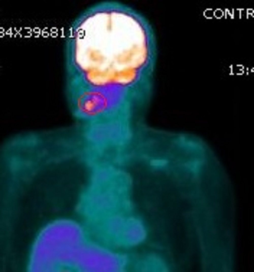 經由正子攝影可看見張男的下頷腺左側（紅色部位）有一顆腫瘤。圖／彰化醫院提供