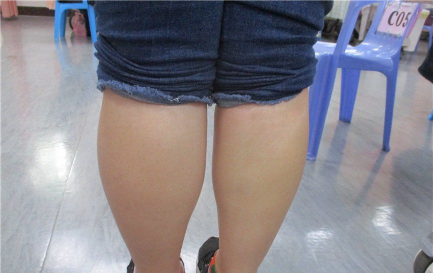 劉小姐左小腿因深部靜脈栓塞，明顯較右小腿腫脹。 圖／新竹台大分院提供