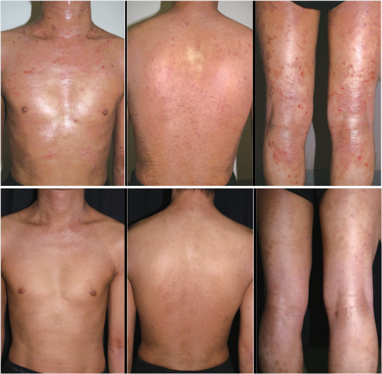上圖為生物製劑治療前，下圖為治療4周後皮膚狀況，病灶逐步明顯改善。 圖/異位性皮...