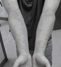 對鎳過敏引起雙手出現接觸性皮膚炎。圖／陳啟信提供