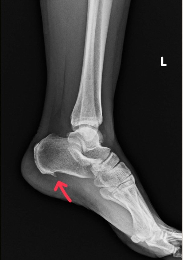 外籍看護足底筋膜炎復發，痛到不能走，X光圖為足後跟痛點。記者王昭月／攝影