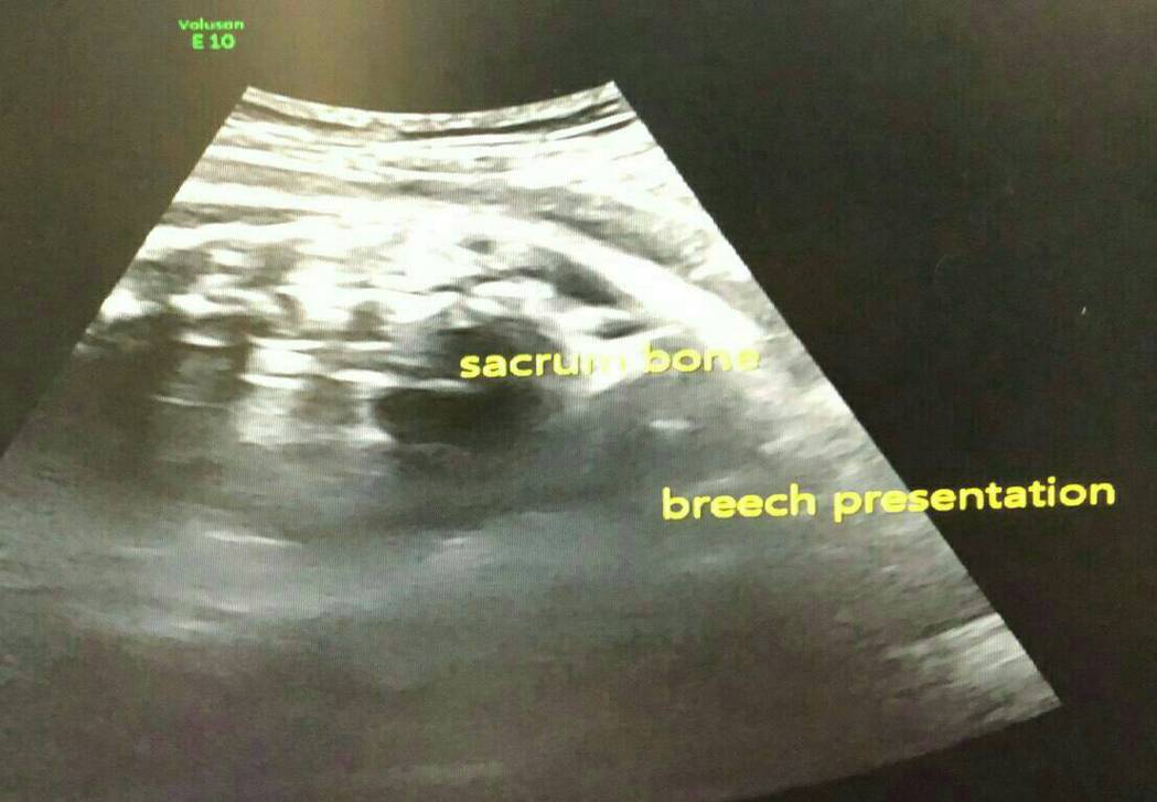 圖片說明：胎位不正檢查片~37+5週，胎兒薦骨位置不對，因為很”大隻”了，超音波...