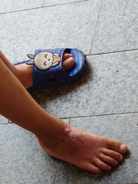 林女的兒子劉小弟左腳嚴重燙傷，傷勢復元狀況不錯，但留下大面積傷疤。記者簡慧珍／攝影