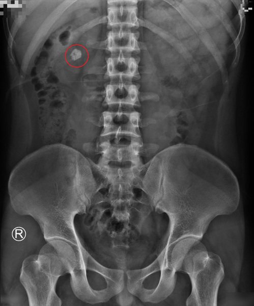 邱姓病患的右腎結石位置。圖／彰化醫院提供