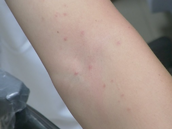 澎湖多位居民最近皮膚出現大量紅疹，醫師評估以「毛毛蟲皮膚炎」可能性最大。圖／高雄長庚醫院提供