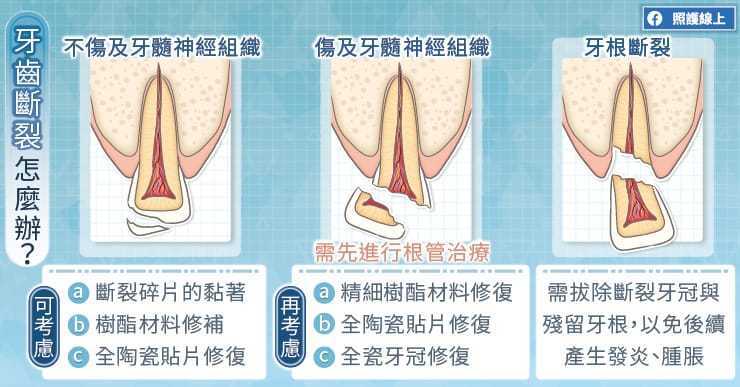 牙齒斷裂位置不同，處理方式也不同