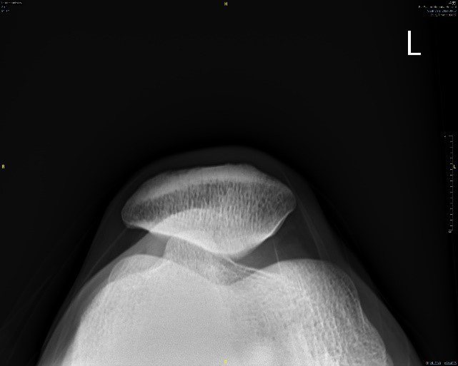 （圖一）X光了解髕骨外翻的程度