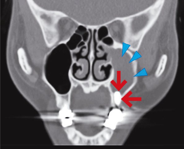 圖二：植牙（紅色箭頭）後產生左側鼻竇炎藍色標示為範圍。圖／羅盛典提供