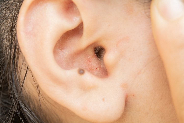 外耳道異物的臨床表現差異大，體積小無刺激性的異物，可能無任何症狀，經常於看診時醫...