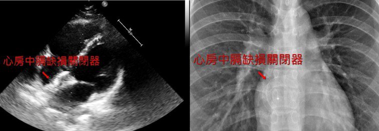 術後超音波與胸部X光顯示心房中膈缺損關閉器於適當位置。圖／院方提供