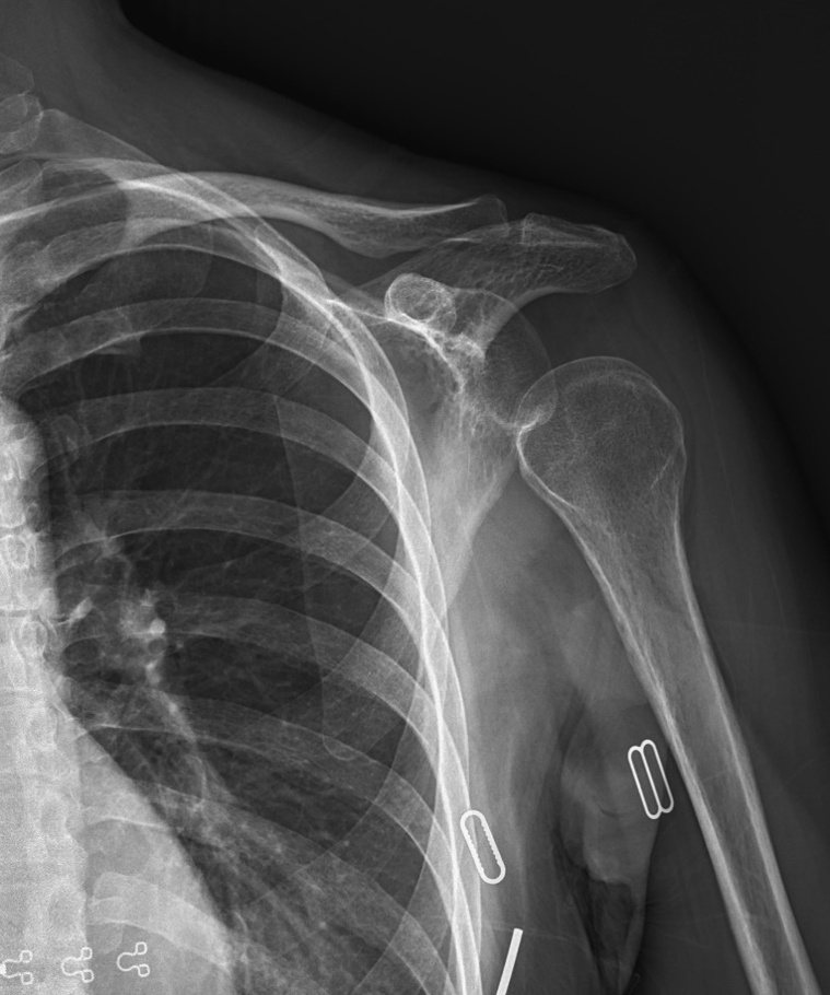 中風患者X光片影像，可看到肩部半脫位。圖／南投醫院提供