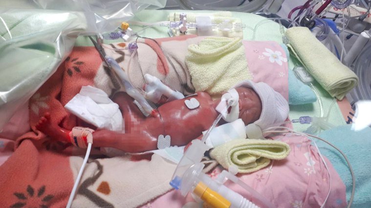 23周6天出生的姐姐。圖／馬偕醫院提供