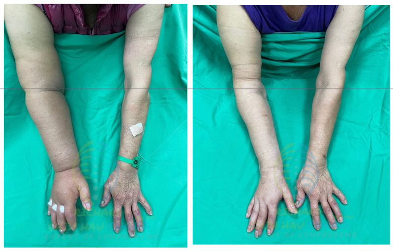 郭女士的右手原本腫脹如米其林（圖左），術後6個月消腫到與正常手臂差不多（圖右）。圖／高醫提供