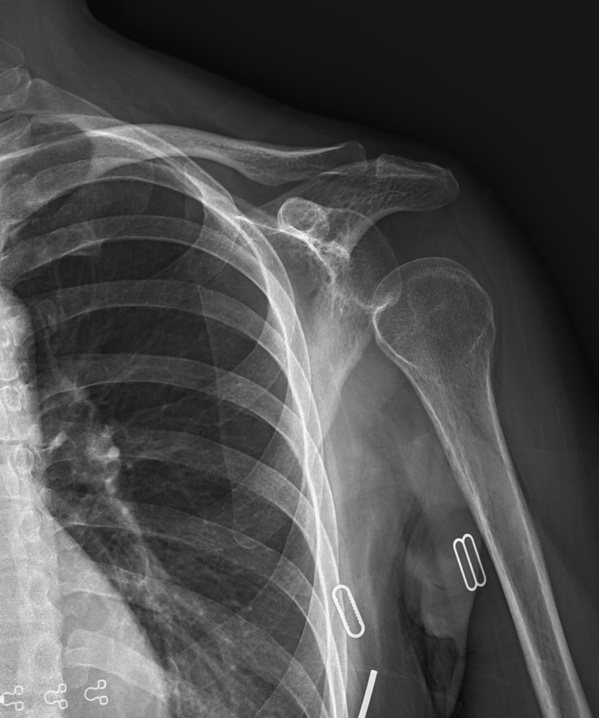 中風患者X光片影像，可看到肩部半脫位。 圖／南投醫院提供