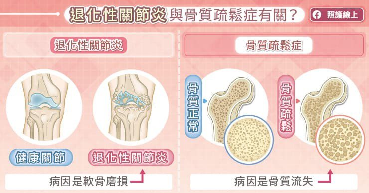 退化性關節炎與骨質疏鬆是不同的疾病，退化性關節炎是以軟骨磨損為主，骨質疏鬆則是骨...