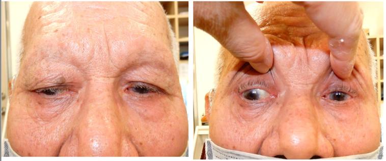 84歲陳老先生右眼（左）罹患眼窩腫瘤，5個月內視力退步至接近全盲，經治療後6個月...