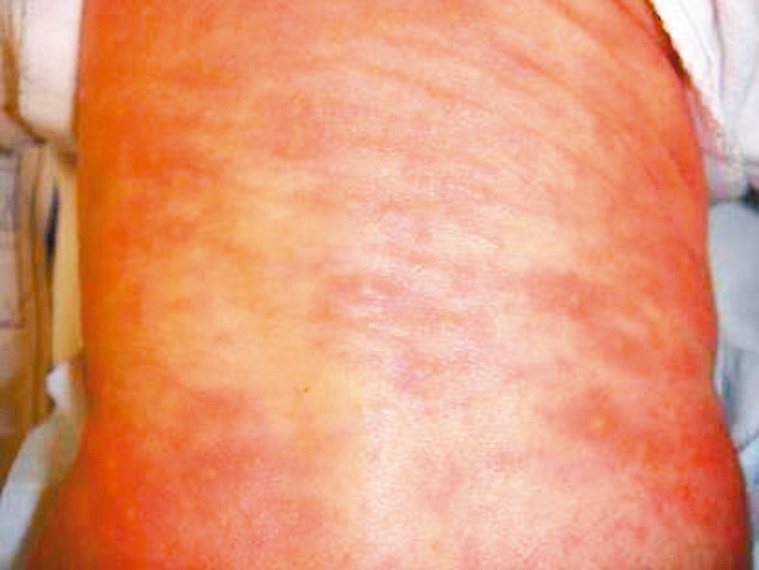 若發現孩子皮膚出現紅疹，建議先就醫確認是什麼病症引起，以利及早治療。圖／新竹國泰...