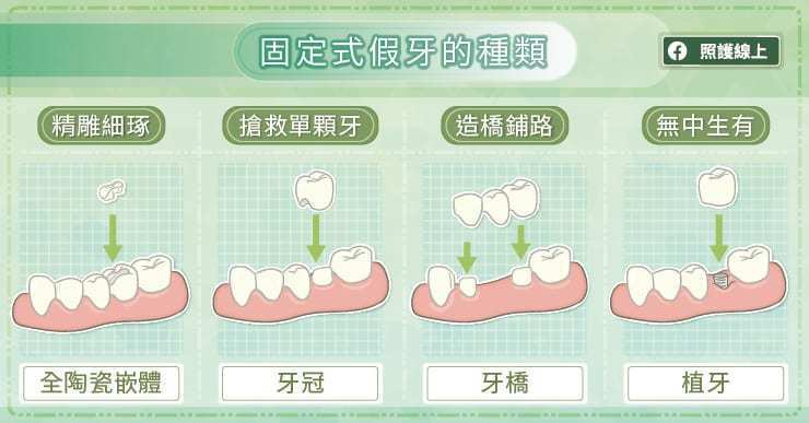 固定式假牙的種類。 圖／照護線上