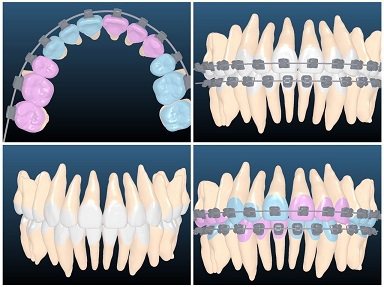歐凱捷醫師根據每顆牙齒的牙冠與牙根型態設計出客製化矯正器，連矯正線也是客製化。 ...