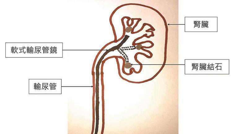 腎臟深處的結石，可以軟式輸尿管鏡碎石清除。圖／彰化秀傳醫院提供