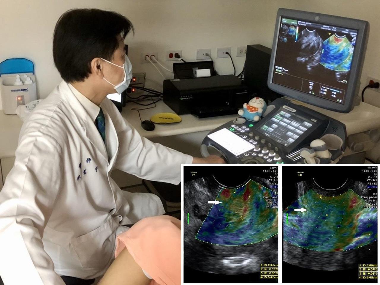 馬偕醫院透過超音波彈性成像技術檢測孕婦子宮頸軟硬，避免因「子宮頸閉鎖不全」造成早產。圖／馬偕提供