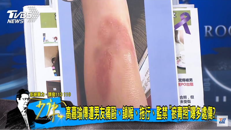 高嘉瑜被男友家暴，整個腿部瘀青痕跡非常明顯。圖擷自TVBS少康戰情室