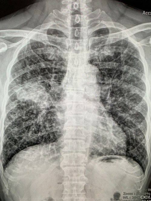 各類的疾病都可能引發慢性咳嗽，需要夠透過照X光才能釐清與確認。 圖／林昌生提供