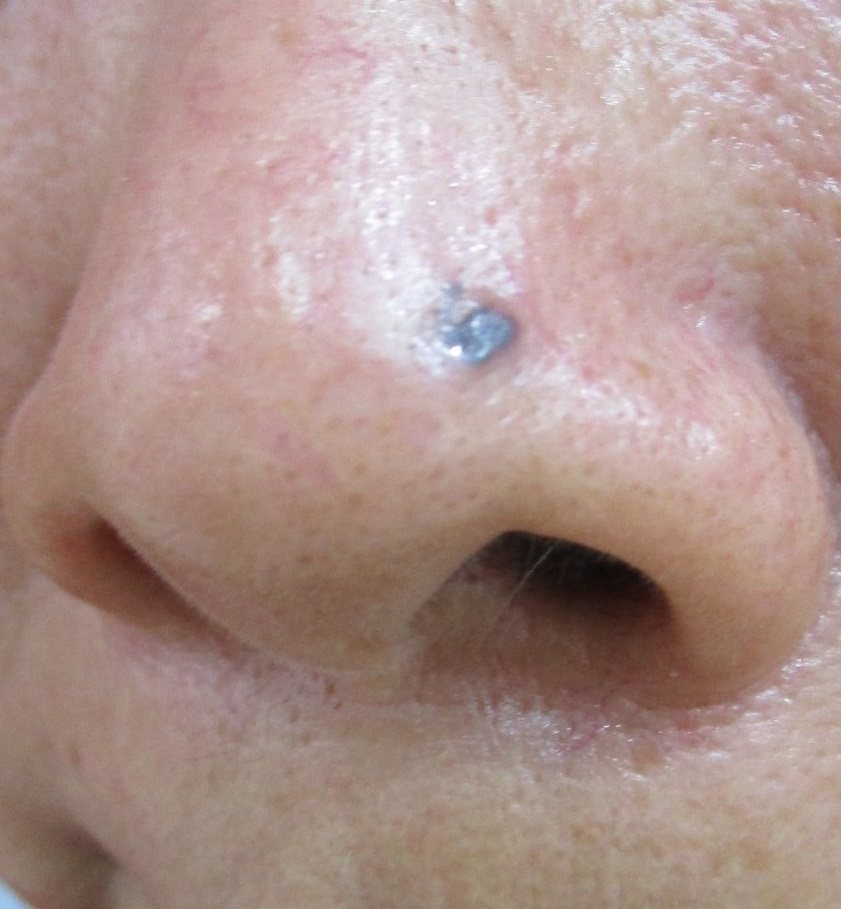皮膚科醫師提醒，鼻頭長痣小心癌變。圖／義大醫院提供