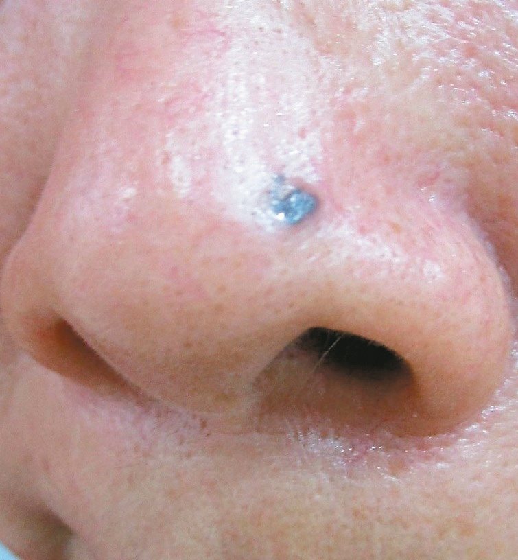皮膚科醫師提醒，鼻頭長痣小心癌變。圖／義大醫院提供
