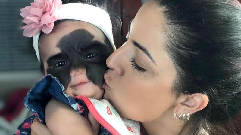 美国2岁女娃天生在脸上有个像蝙蝠侠图案的胎记。图／取自(photo:UDN)