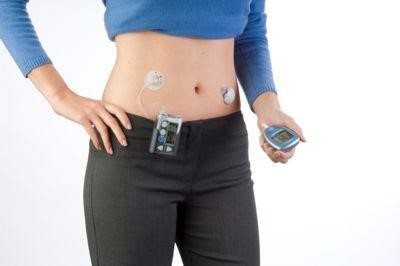 連續式監測血糖儀(圖示人的左邊；錢幣大小貼在肚子上面)和胰島素自動注射系統(右)...
