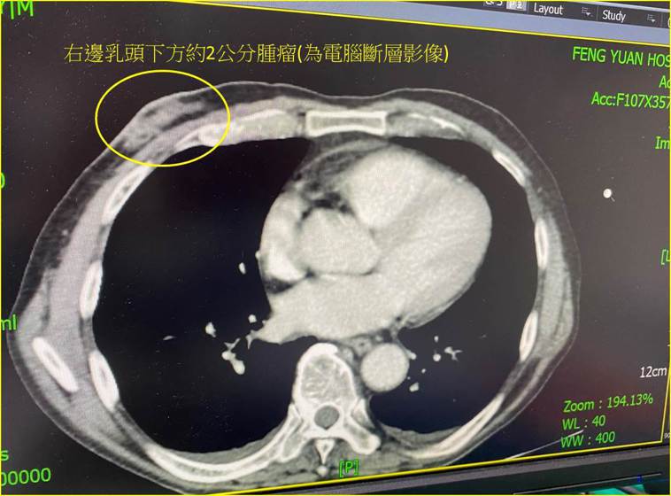 電腦斷層影像顯示，施姓老翁右邊乳頭下方約有2公分腫瘤。圖／衛福部豐原醫院提供