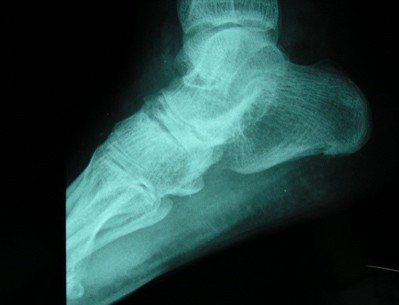 圖三、踝關節Ｘ光顯示關節腔狹窄，僵直性脊椎炎可能造成下肢膝蓋或腳踝的寡關節炎