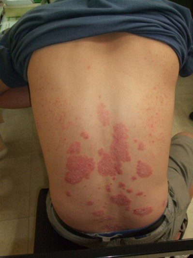 圖一、背部的乾癬。乾癬可能出現在少數僵直性脊椎炎病人，表現為界限明顯的表皮增厚，...