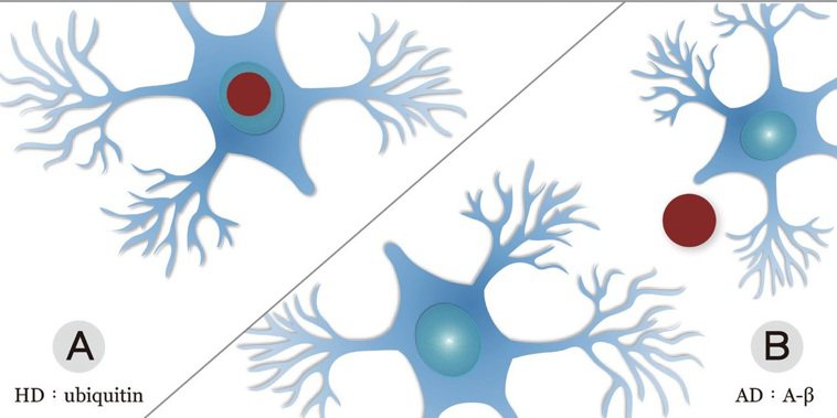 神經細胞蛋白質不正常堆積不同神經退化疾病中，神經細胞都有蛋白質不正常堆積的情...