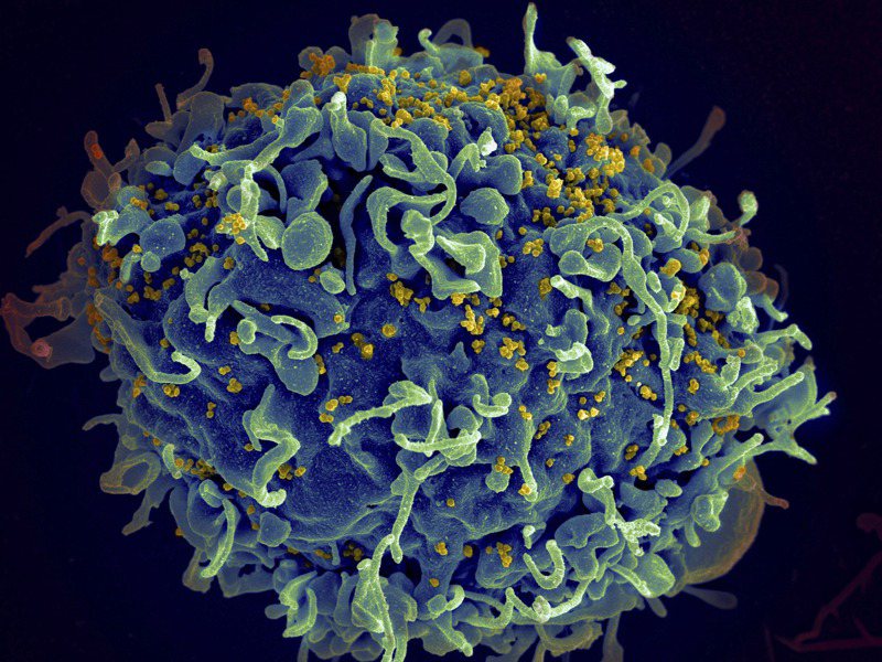 美国国家卫生研究院发布的电子显微镜影像显示，蓝色的人类T细胞被黄色的爱滋病毒攻击。图／美联社(photo:UDN)