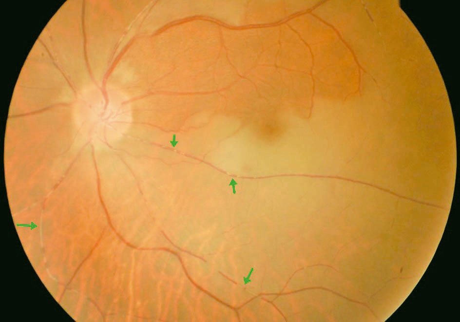 視網膜動脈阻塞眼中風，因水腫呈現灰白色澤(箭頭標示處)。圖／衛福部台北醫院提供