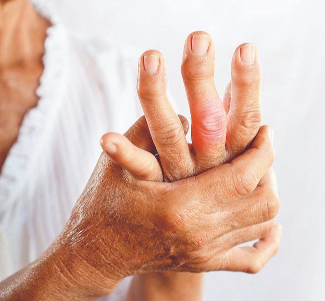 類風濕性關節炎因免疫系統失衡，攻擊自身關節，以致手腳關節持續發炎腫痛，扭曲變形。...