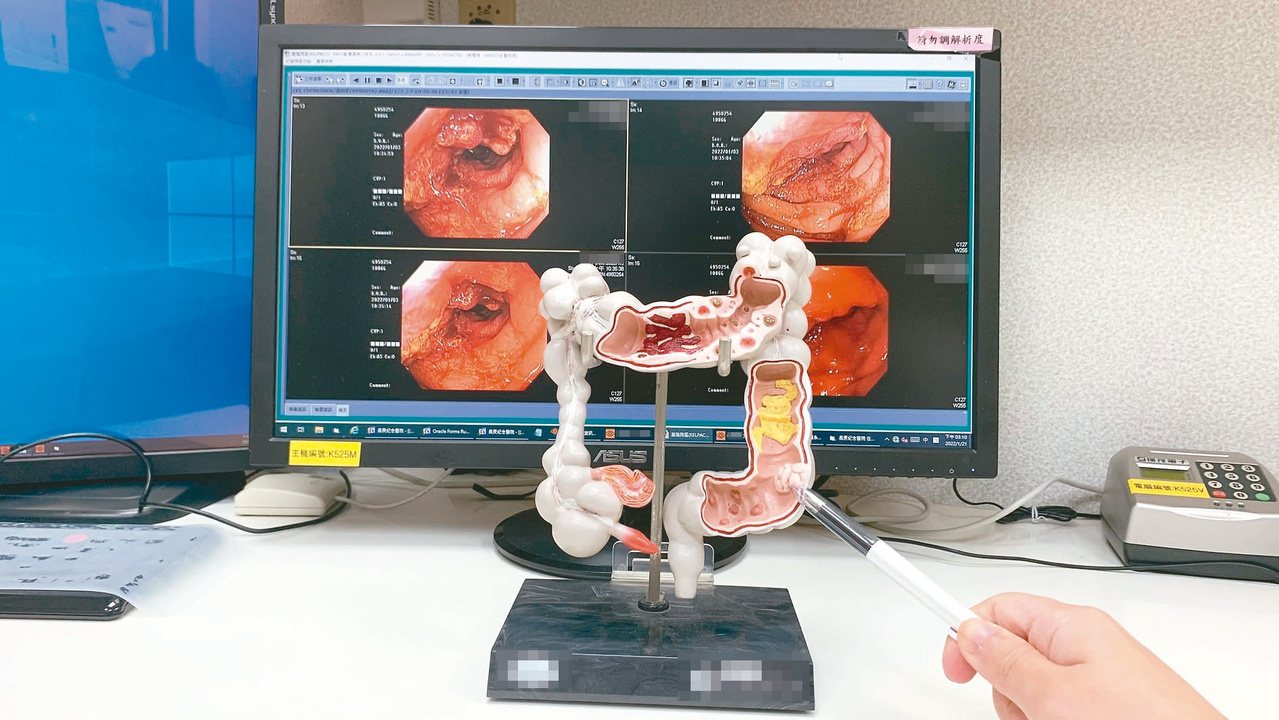 患者接受大腸鏡，發現乙狀結腸有惡性腫瘤（圖中原子筆所指之處）。圖／醫師游彥麟提供